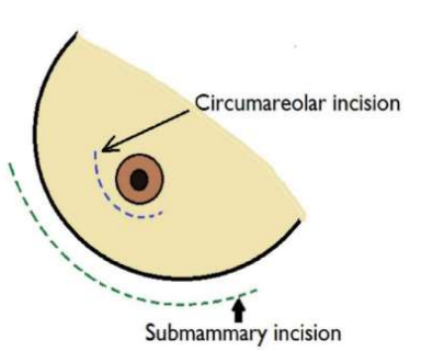 circumareolar_dan_submammary_incision.png